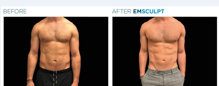 A Comprehensive Comparison of Emsculpt Neo vs. Airsculpt Body Sculpting